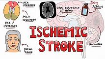 Ischemia Symptoms and Diagnosis: What You Need to Know