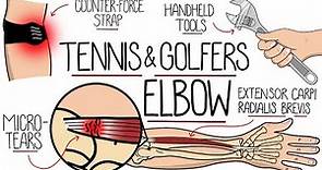 Understanding Tennis Elbow and Golfer's Elbow (Lateral & Medial Epicondylitis)