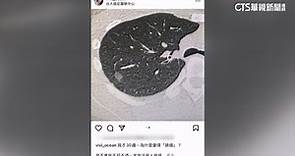 不菸不酒罹肺癌　「最美護理師」崩潰：我才30歲 - 華視新聞網