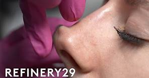 I Tried A Non-Surgical Nose Job | Macro Beauty | Refinery29
