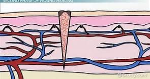 Stages of Wound Healing | Overview, Process & Timeline