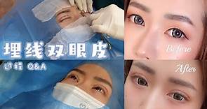 埋線雙眼皮過程 👀 【雙眼皮Q&A】多少錢？ 雙眼皮修復後第一個拍攝幕後花絮！