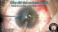 CataractCoach 1435: why did nucleus drop in cataract surgery?