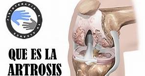 Que es la artrosis y como se produce