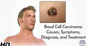 Basal Cell Carcinoma: Causes, Symptoms, Diagnosis and Treatment.