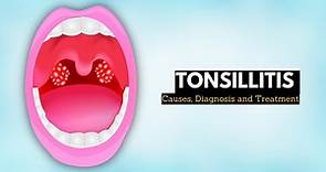Tonsillitis, Causes, Signs and Symptoms, Diagnosis and Treatment.