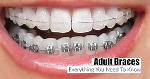 Adult Braces, Everything You Need To Know!- MissLizHeart