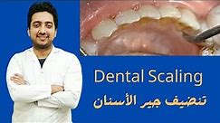 Dental Scaling And Polishing 1