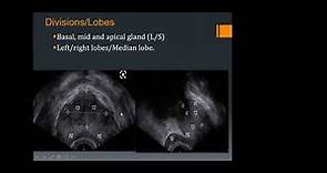 Key aspects of Prostate Ultrasound