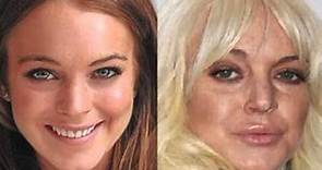 Lindsay Lohan Before and After Plastic Surgery Photos