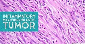 IMT: Inflammatory Myofibroblastic Tumor...Explained by a Soft Tissue Pathologist