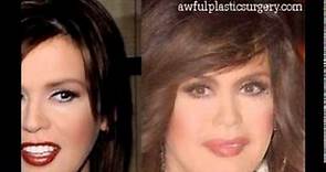 Marie Osmond plastic surgery before and after photos