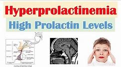Hyperprolactinemia (High Prolactin Levels) | Causes, Signs & Symptoms, Diagnosis, Treatment