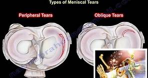 knee pain, Meniscus Tear ,types- Everything You Need To Know - Dr. Nabil Ebraheim