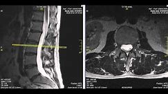 Normal Lumbar Spine MRI Explained | Dr. Jeffrey P. Johnson | HD