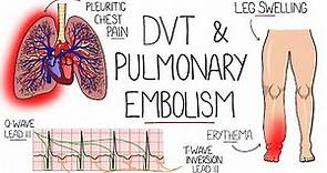 Deep Vein Thrombosis (DVT) & Pulmonary Embolism Explained