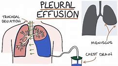Understanding Pleural Effusions