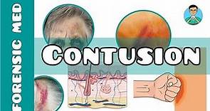 Contusion | What is a contusion injury | What causes of bruising | What are the types of bruises?