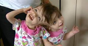 Conjoined Twins: Twin Girls, A Medical Wonder