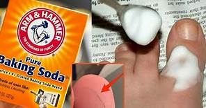 How To Remove a Splinter With Baking Soda | Happy Life