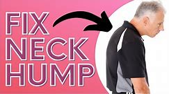 How You Can Get Rid of Neck Hump With a SOCK. Dowager's Hump.