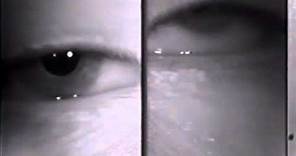 Ocular Myasthenia - Tensilon Test