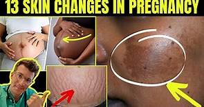 Doctor explains 13 SKIN SIGNS AND CHANGES SEEN IN PREGNANCY (plus real life clinical photos)