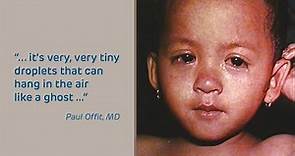 Measles: symptoms, spread & SSPE | Doctors Talk | Children’s Hospital of Philadelphia