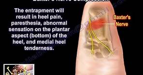 The Baxter's Nerve and plantar fasciitis - Everything You Need To Know - Dr. Nabil Ebraheim