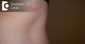 Management of rashes near buttocks - Dr. Aruna Prasad