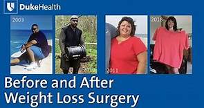 Before and After Weight Loss Surgery | Duke Health