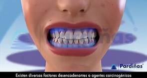 El CÁNCER ORAL - Causas, síntomas y tipos de tumores en la boca ©