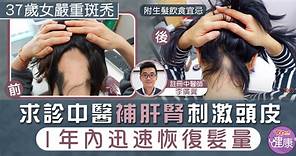 【脫髮治療】37歲女嚴重斑禿求診中醫　補肝腎刺激頭皮1年内迅速恢復髮量 - 香港經濟日報 - TOPick - 健康 - 保健美顏