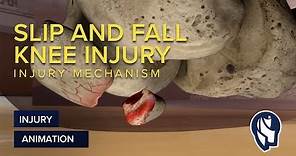 Slip and Fall Knee Injury Mechanism Animation