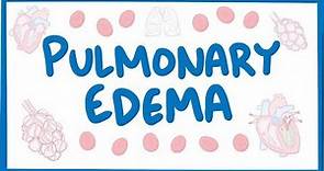 Pulmonary Edema - causes, symptoms, diagnosis, treatment, pathology