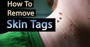 How to Remove Skin Tags | Skin tags – causes, symptoms, and removal