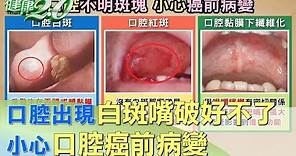 口腔出現白斑、嘴破好不了 小心口腔癌前病變 健康2.0