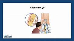 Pilonidal Cyst