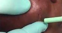 Extra oral abscess drain