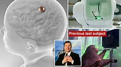 Elon Musk’s startup Neuralink implants chip into brain of first human test subject
