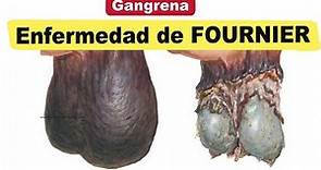 Enfermedad de FOURNIER causas - Gangrenaregión perineal
