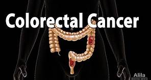 Colon Cancer: Pathology, Symptoms, Screening, Cause and Risk Factors, Animation