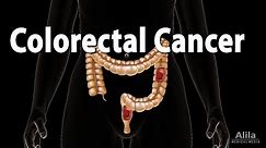 Colon Cancer: Pathology, Symptoms, Screening, Cause and Risk Factors, Animation