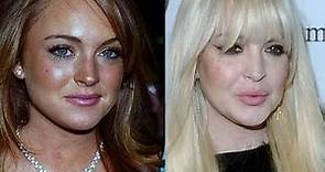 Lindsay Lohan Plastic Surgery – Breast Implants, Nose Job & Lip Injections
