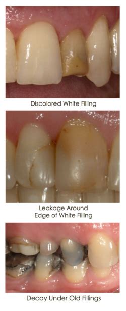 tooth filling discoloration
