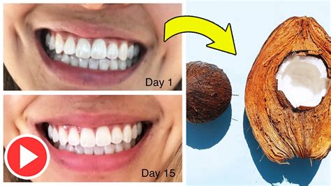 Oil Pulling with Coconut Oil