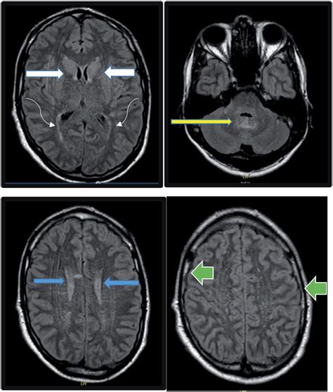 Abnormal Brain MRI