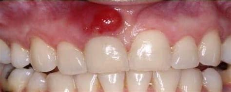 Absceso Periapical Ag… 