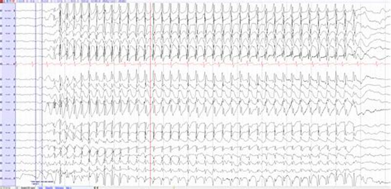 Absence Eeg Pattern