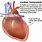 Acute Cardiac Tamponade